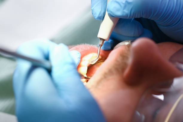 Best Emergency Treatment for Dental Infections or Abscesses in Montgomery, AL