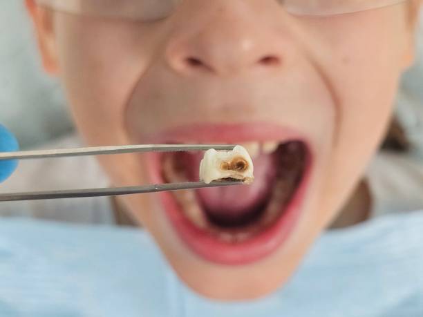 Best Emergency Tooth Extraction in Montgomery, AL