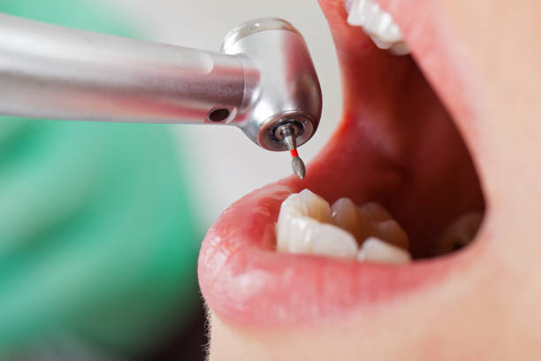 Best Urgent Care for Lost Fillings or Crowns in Montgomery, AL